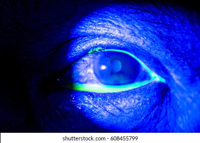 82 Corneal Abrasion Images, Stock Photos & Vectors | Shutterstock