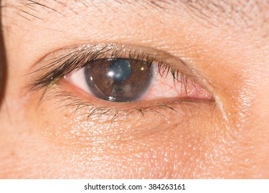 Close Common Eye Infection Inflamnmation During Stock Photo 607140869 ...