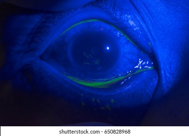close up of corneal ulcer during ophthalmic examination.