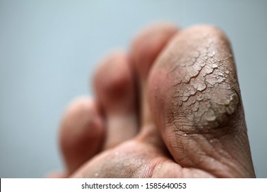 cracked big toe