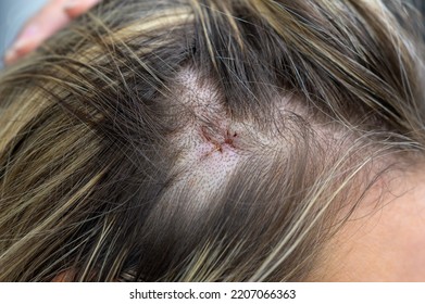 Close up cropped of a blonde woman's head with a recent surgery scar holding her hair to the side with a hand - Shutterstock ID 2207066363