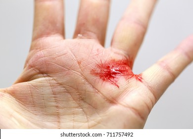 Close Up Of A Cut Hand With Bleeding And Tiny Shards Of Glass.