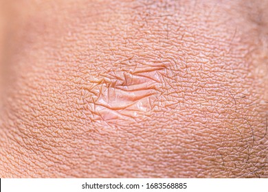 Close Cyanotic Keloid Scar Caused By Stock Photo Shutterstock