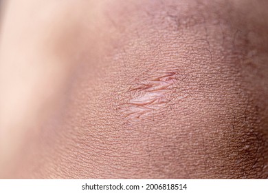 Close Cyanotic Keloid Scar Caused By Shutterstock