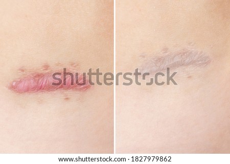 Close up of cyanotic keloid scar caused by surgery and suturing, skin imperfections or defects before and after treatment and laser removal. Hypertrophic Scar on skin, dermatology and cosmetology.
