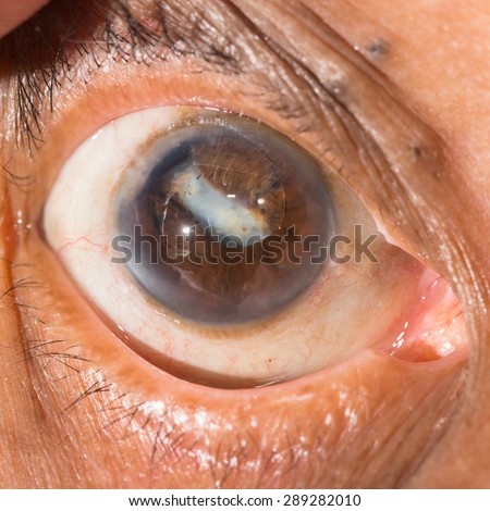 close up of the dense posterior capsular opacity during eye examination.