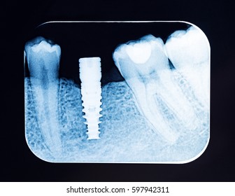 Close Up Dental X Ray Screw Implant