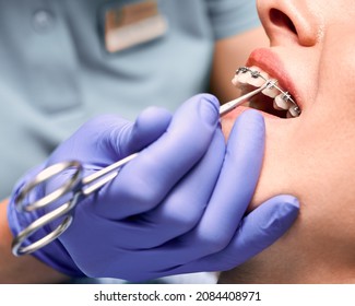 Close up of dentist hand putting elastic rubber band on patient brackets. Woman with wired metal braces on teeth receiving orthodontic treatment. Concept of stomatology, dentistry and orthodontics.