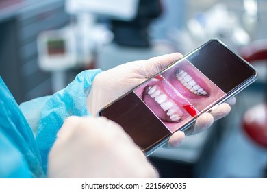 Close Up Of Dentist Hands Holding Phone And Showing Patient’s Teeth Before And After Dental Surgery. Wearing Protective Clothes And White Gloves.