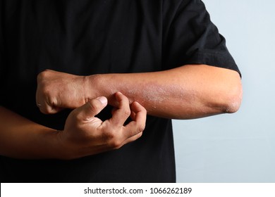 Close up dermatitis on skin, ill allergic rash dermatitis eczema skin of patient , atopic dermatitis symptom skin detail texture , Fungus of skin ,The concept dermatology, treatment fungal and fungal