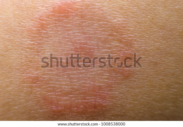 Close Dermatitis On Skin Ill Allergic Photo De Stock Modifiable 1008538000