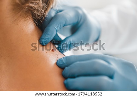 Close up of dermatologist examining patient birthmark in clinic