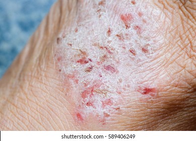 Close Up Of Dermatophytes Athlete 's Foot Or Tinea Pedis.