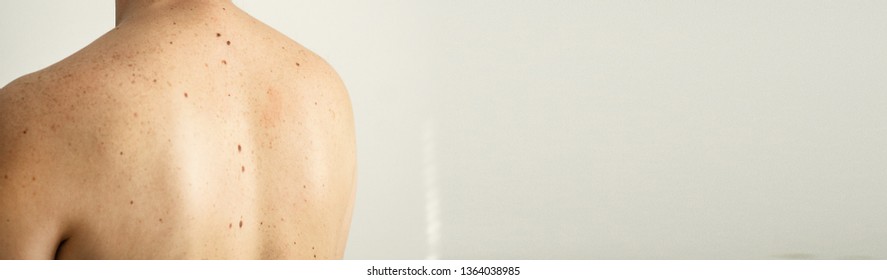 Close Up Detail Of The Bare Skin On A Man Back With Scattered Moles And Freckles. Checking Benign Moles. Sun Effect On Skin. Birthmarks On Skin

