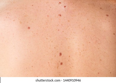 Close Up Detail Of The Bare Skin On A Man Back With Scattered Moles And Freckles. Checking Benign Moles. Sun Effect On Skin. Birthmarks On Skin