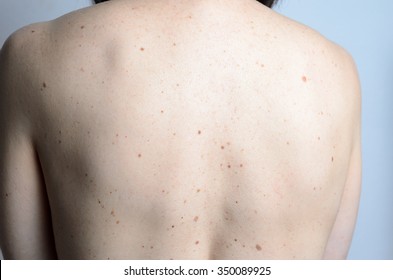 Close Up Detail Of The Bare Skin On A Womans Back With Scattered Moles And Freckles