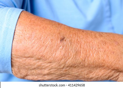 Close Up Detail Of The Forearm Of An Elderly Woman Showing The Wrinkles And Age Spots Of The Skin In A Sign Of Old-age And Loss Of Elasticity