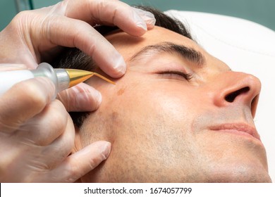 Close Up Detail Of Laser Plasma Pen Removing Facial Moles On Middle Aged Man.