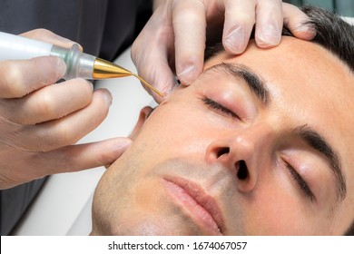 Close Up Detail Of Laser Plasma Pen Removing Facial Moles On Middle Aged Man.