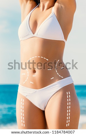 Close up detail of slim female torso with conceptual body contour incision lines. Hips and abdomen marked for liposuction.