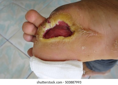 Close up Diabetic foot ulcers , selective focus.