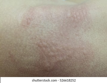 Close Up Diaper Rash