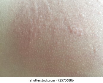 Close Up Diaper Rash