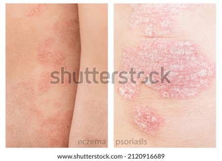 Close up difference between Psoriasis and Eczema, atopic dermatitis. Chronic skin disease