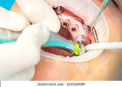 Close Up Of Digital Guided Implant Surgery On Patient - New Implant Technology In Dentistry - Selective Focus