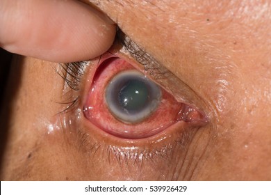 Close Up Of Dilated Pupil During Eye Examination.