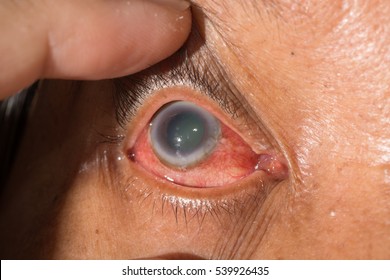 Close Up Of Dilated Pupil During Eye Examination.