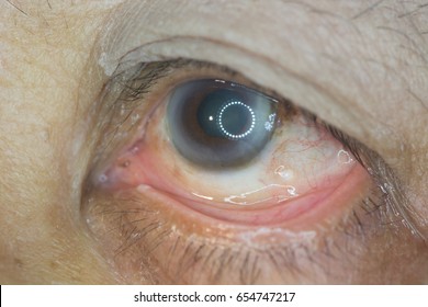 close up of dilated pupil during ophthalmic examination.