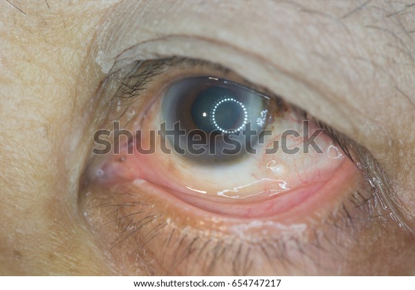close\
up of dilated pupil during ophthalmic\
examination.