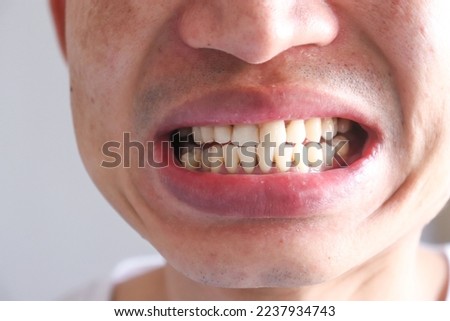 Close up dirty teeth should be treated with caries