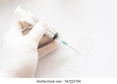 Close Up Doctor Hand During Smear Fine Needle Aspiration (FNA) From Specimen Breast.Non Gynae Specimen For Cytology And Pathology Diagnosis. Medical Treatment Concept.