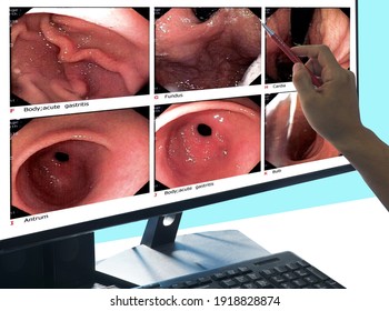 Close up Doctor point out the computer screen, report of gastrointestinal endoscopy, medical imaging EGD looking for structures in the esophagus.Medical image concept.
