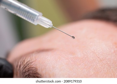 Close Up Of A Drop Of A Drug Falling From A Syringe Needle On The Forehead Of A Male Patient Of A Cosmetology Office. Rejuvenation Procedure, Botox Injections Against Facial Wrinkles