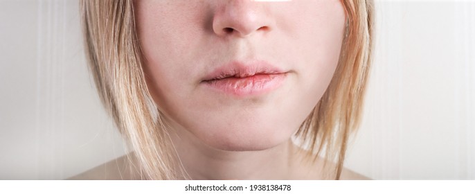 Close Up Of Dry Chapped Lips. Woman Dry Lips With Cracks