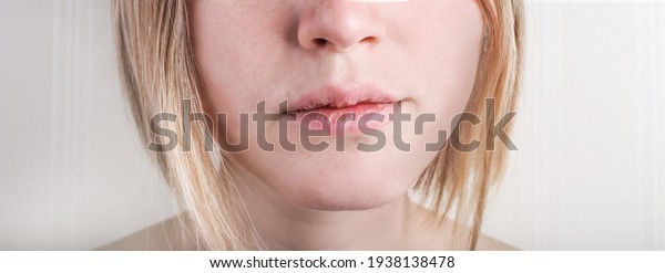 Close\
up of dry chapped lips. Woman dry lips with\
cracks