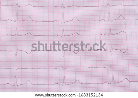 Close up of ECG cardiogram pulse graph on a paper. Medical examination cardiogram