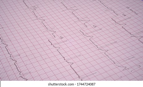 Close Up Echocardiograph Test Report (ECG) Showing Abnormal Heart Rhythm.