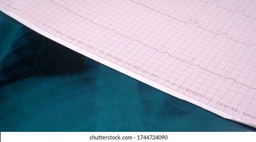 Close Up Echocardiograph Test Report (ECG) Showing Abnormal Heart Rhythm.