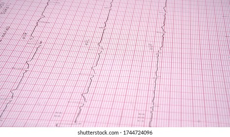 Close Up Echocardiograph Test Report (ECG) Showing Abnormal Heart Rhythm.