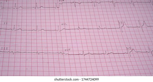 Close Up Echocardiograph Test Report (ECG) Showing Abnormal Heart Rhythm.