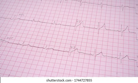 Close Up Echocardiograph Test Report (ECG) Showing Abnormal Heart Rhythm.