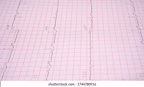 Close Up Echocardiograph Test Report (ECG) Showing Abnormal Heart Rhythm.