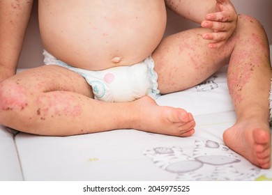 Close Up Enterovirus On Baby Body