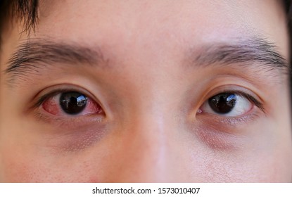 Close Up Eye, Acute Conjunctivitis Patient, Asian Patient Has Red Eyes And Feeling Pain, Infection Eye 