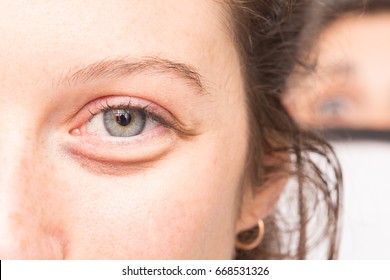 Close Up Of Eye Bag On A Young Girl