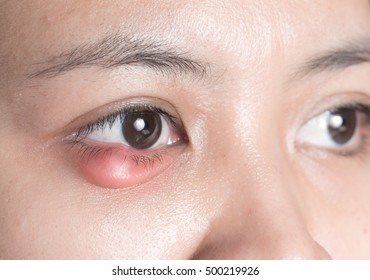 Close Up Of Eyelid Abscess (stye, Hordeolum) 